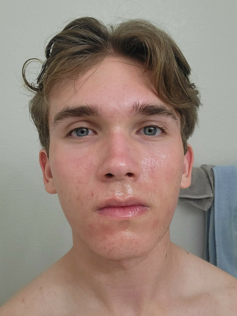 
                  
                    Glow & Go Acne Set
                  
                